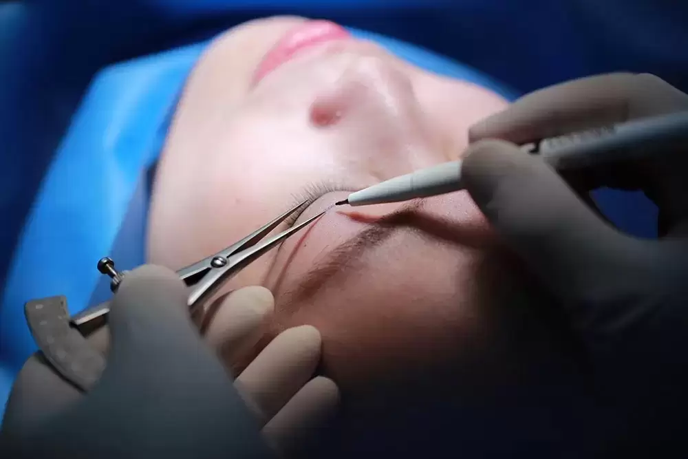 کاندید جراحی اپی کانتوپلاستی